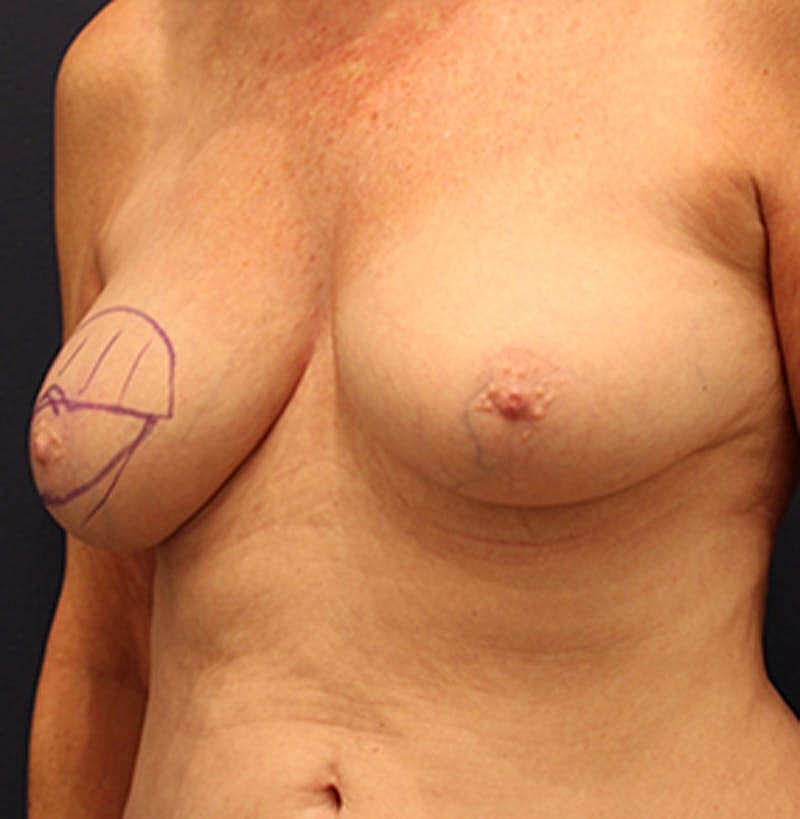 Breast Reconstruction Before & After