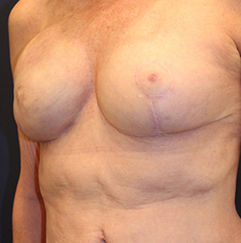 Breast Reconstruction Before & After