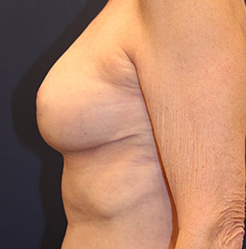 Breast Reconstruction Before & After