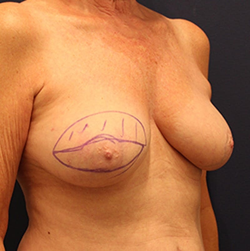 Breast Reconstruction Before & After