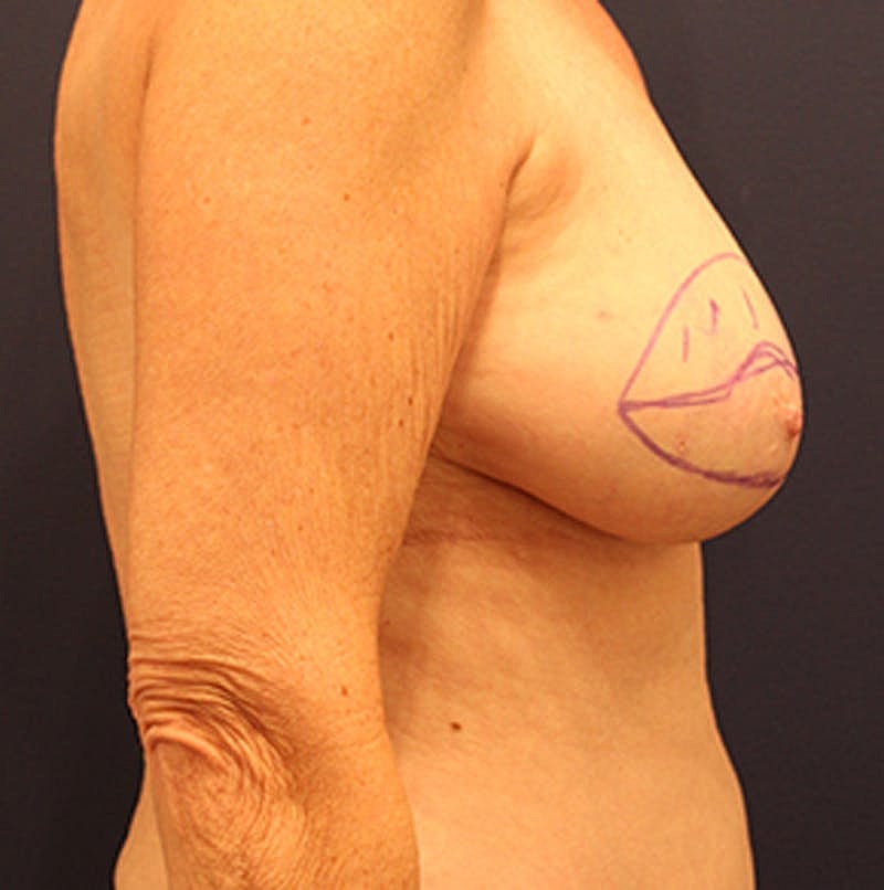 Breast Reconstruction Before & After