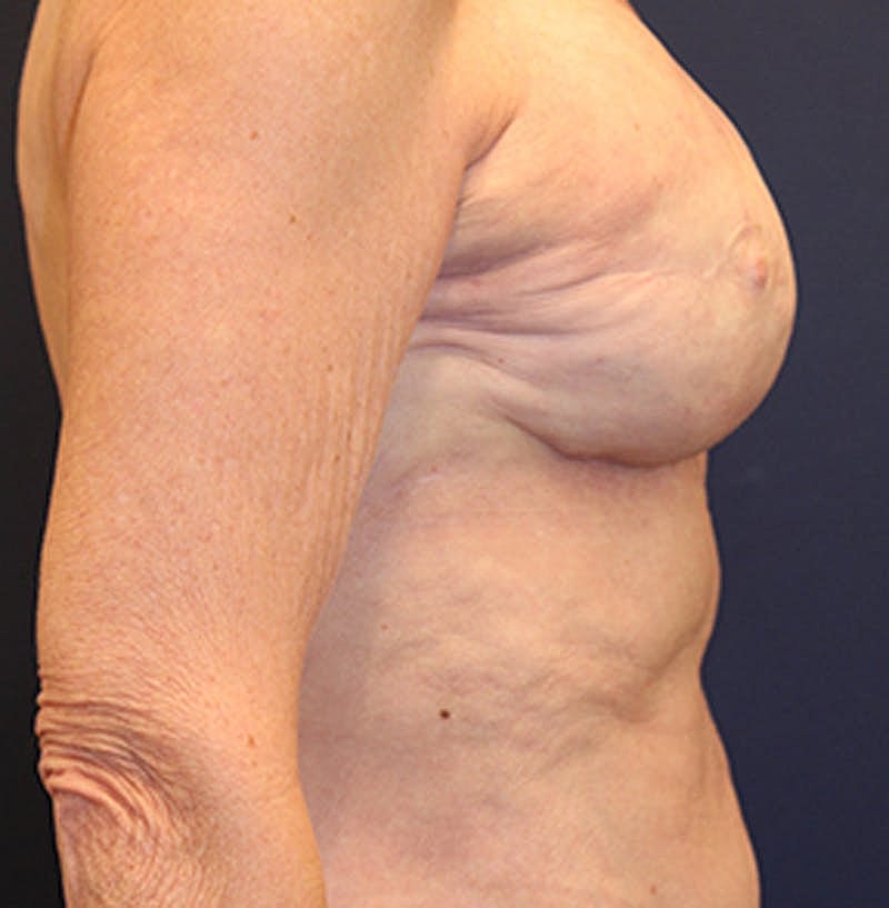 Breast Reconstruction Before & After