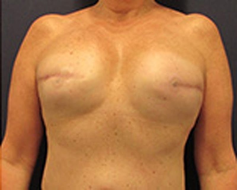 Breast Reconstruction Before & After