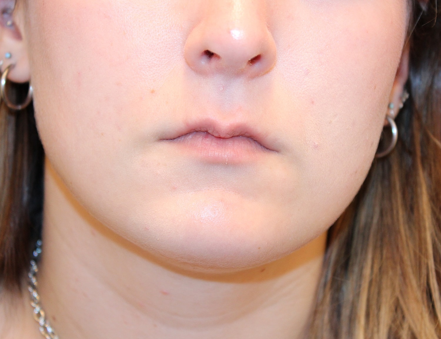 Dermal Fillers Before & After