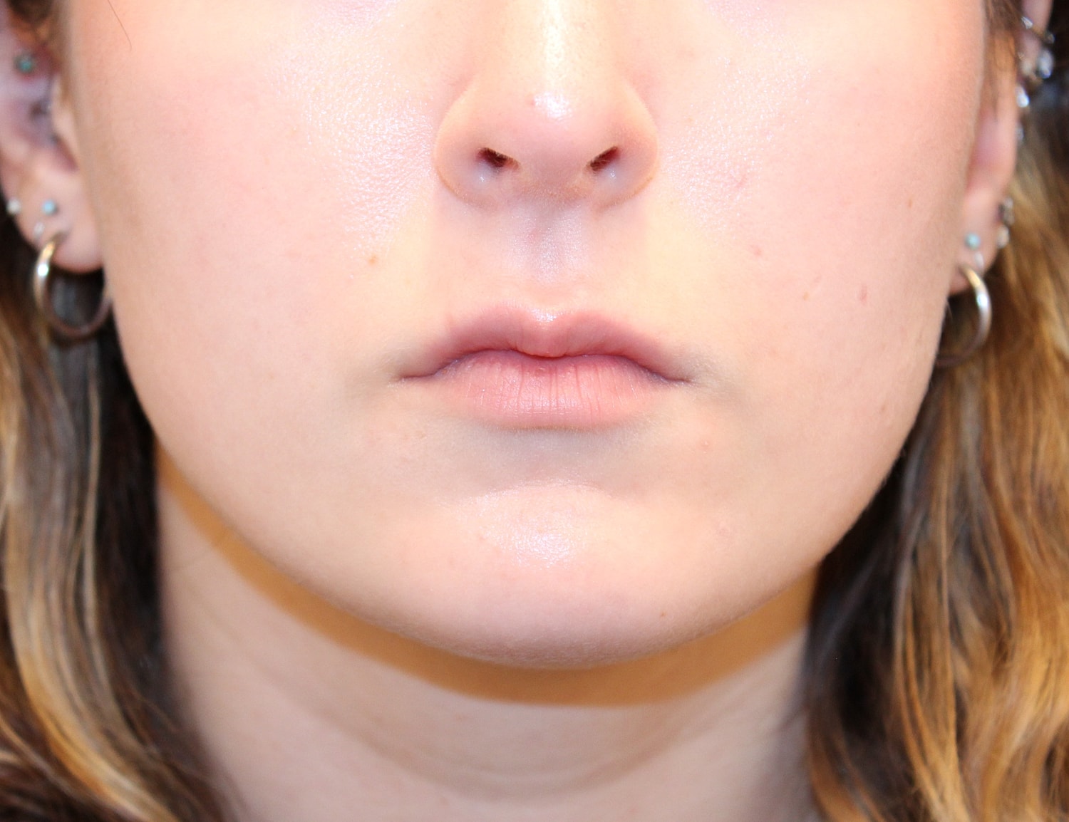 Dermal Fillers Before & After