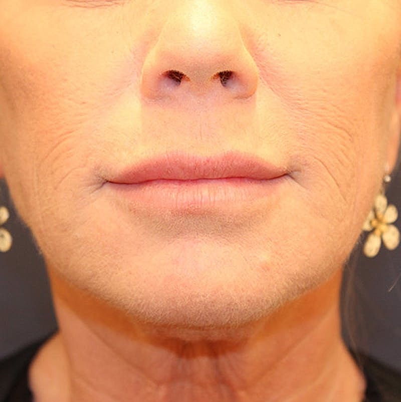 Dermal Fillers Before & After