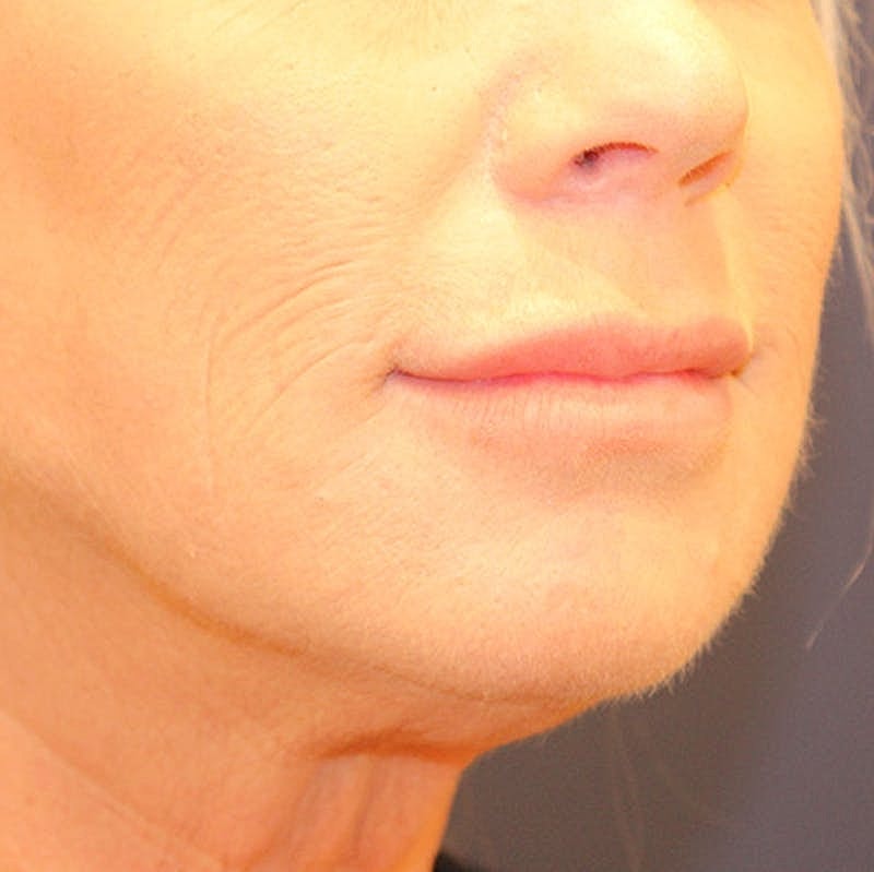 Dermal Fillers Before & After