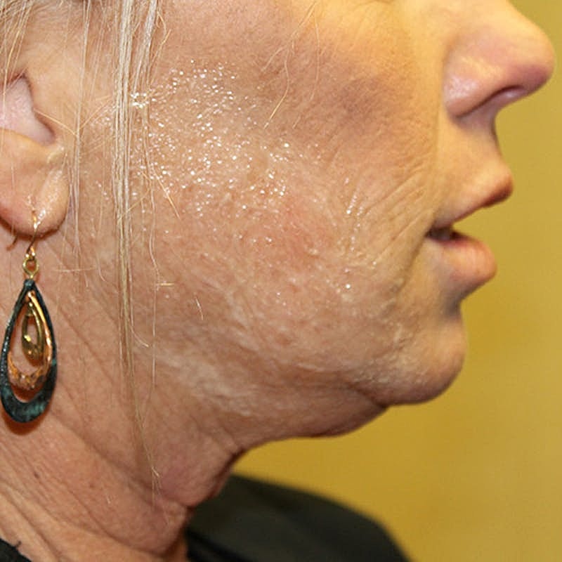 Dermal Fillers Before & After