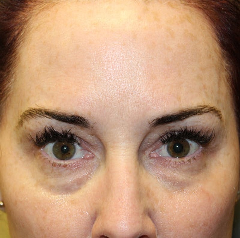 Dermal Fillers Before & After