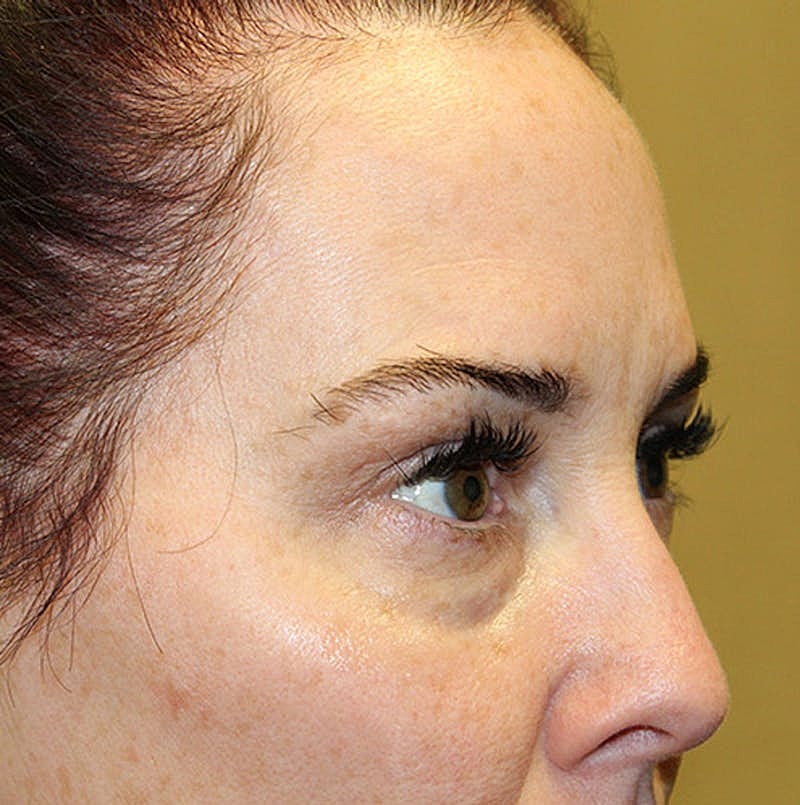 Dermal Fillers Before & After