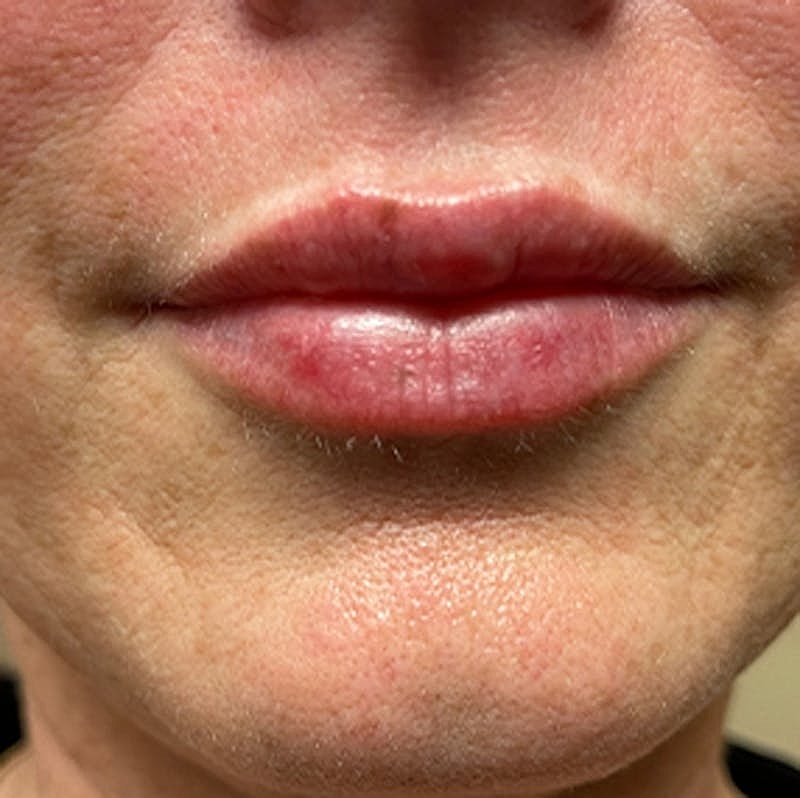 Dermal Fillers Before & After