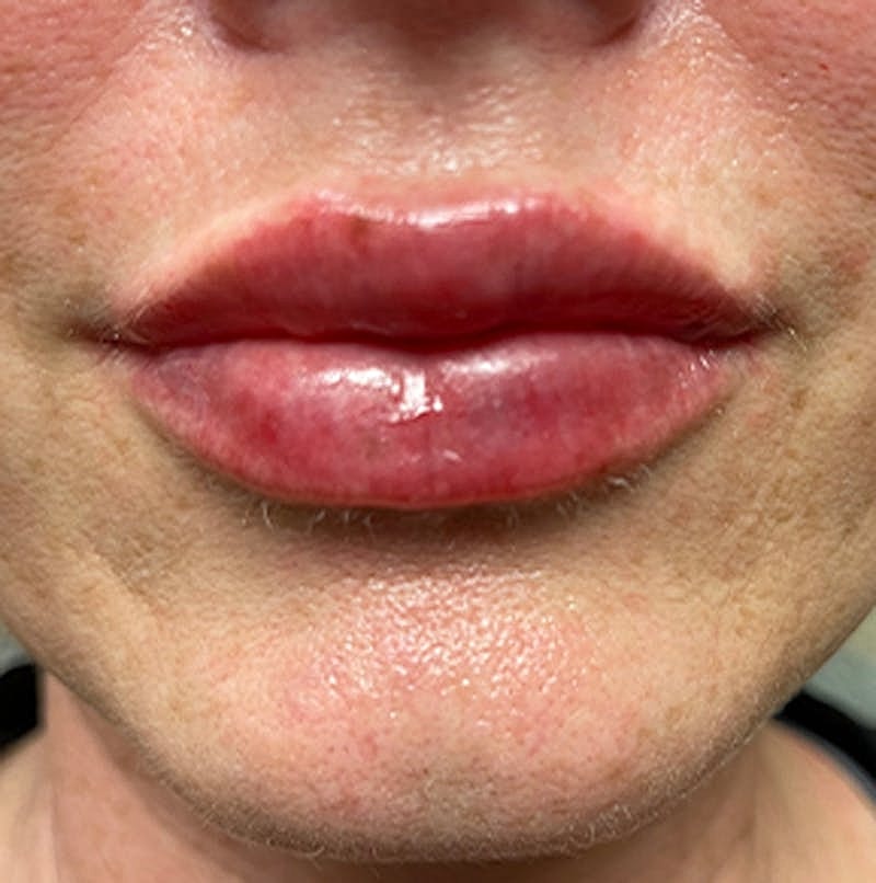 Dermal Fillers Before & After