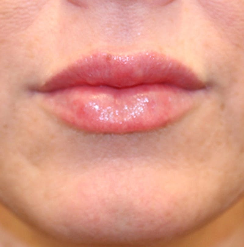 Dermal Fillers Before & After