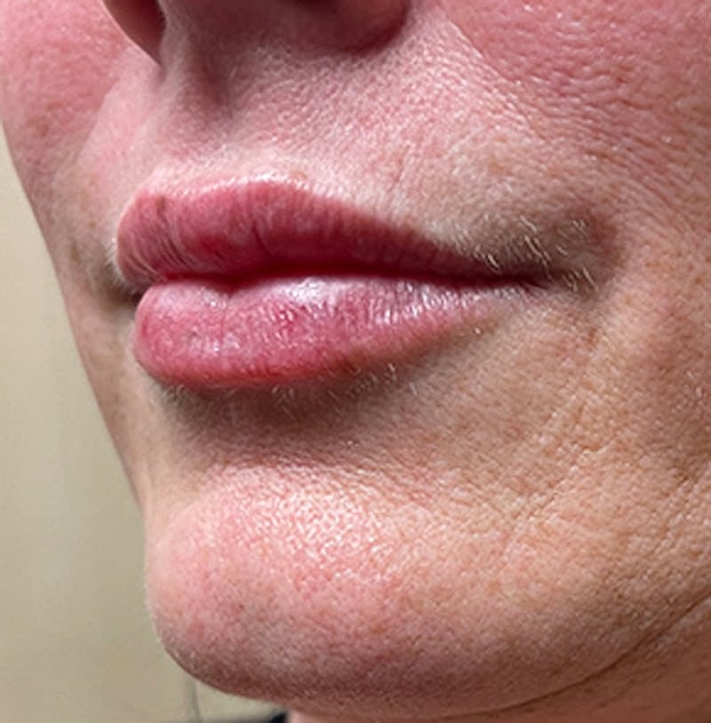 Dermal Fillers Before & After