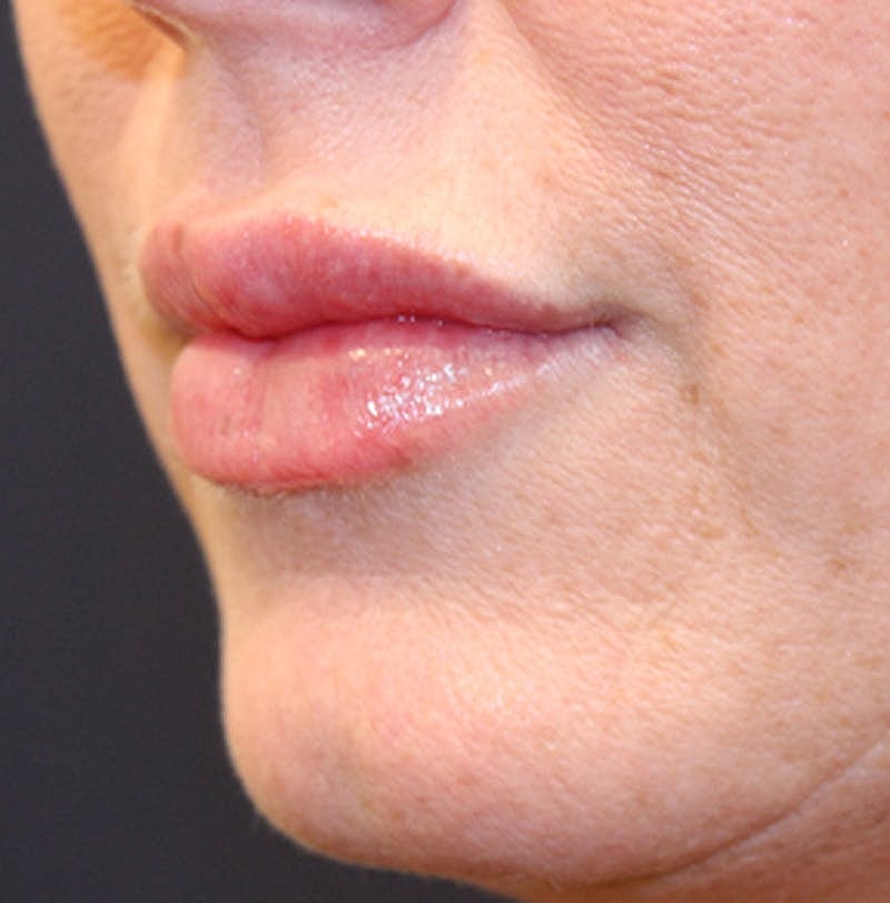 Dermal Fillers Before & After