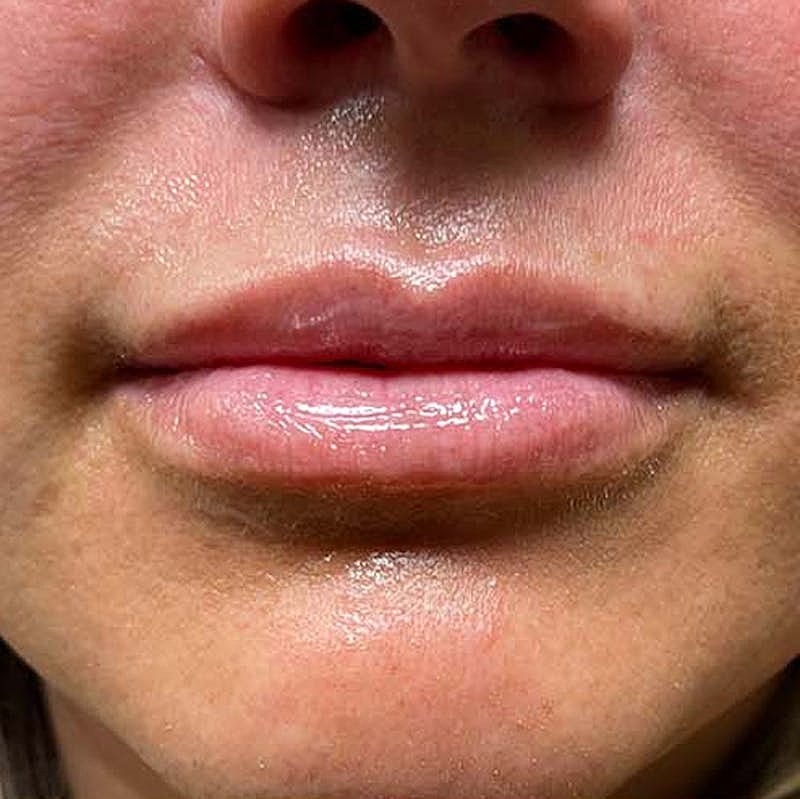 Dermal Fillers Before & After