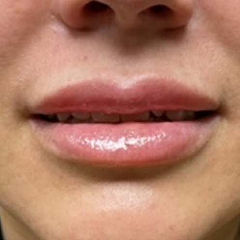 Dermal Fillers Before & After