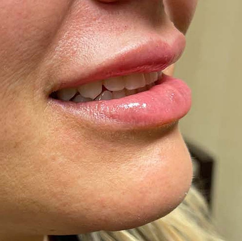 Dermal Fillers Before & After