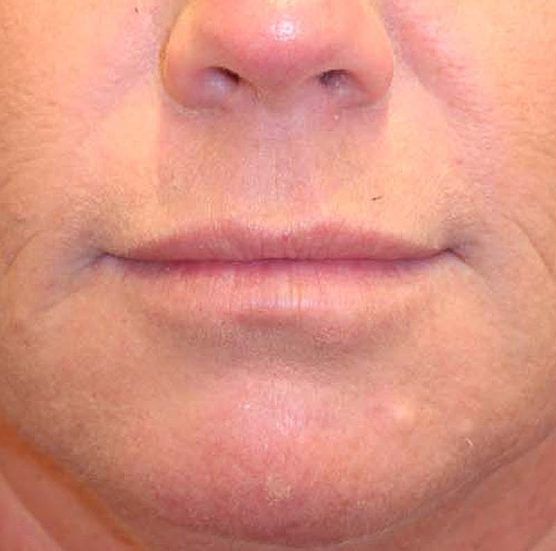 Dermal Fillers Before & After