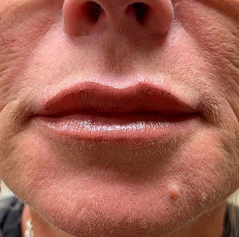 Dermal Fillers Before & After