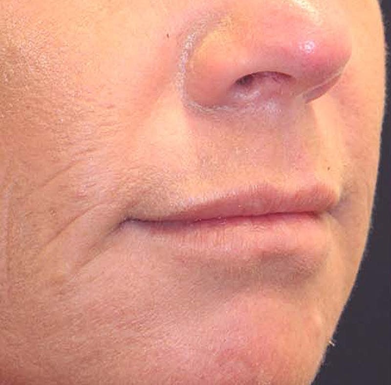 Dermal Fillers Before & After