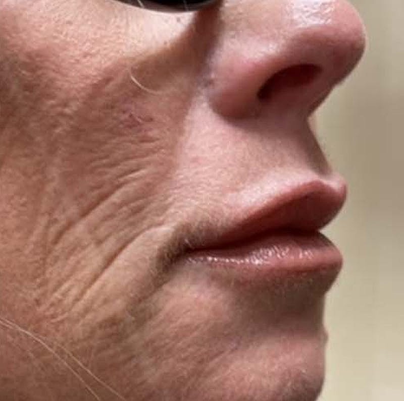 Dermal Fillers Before & After