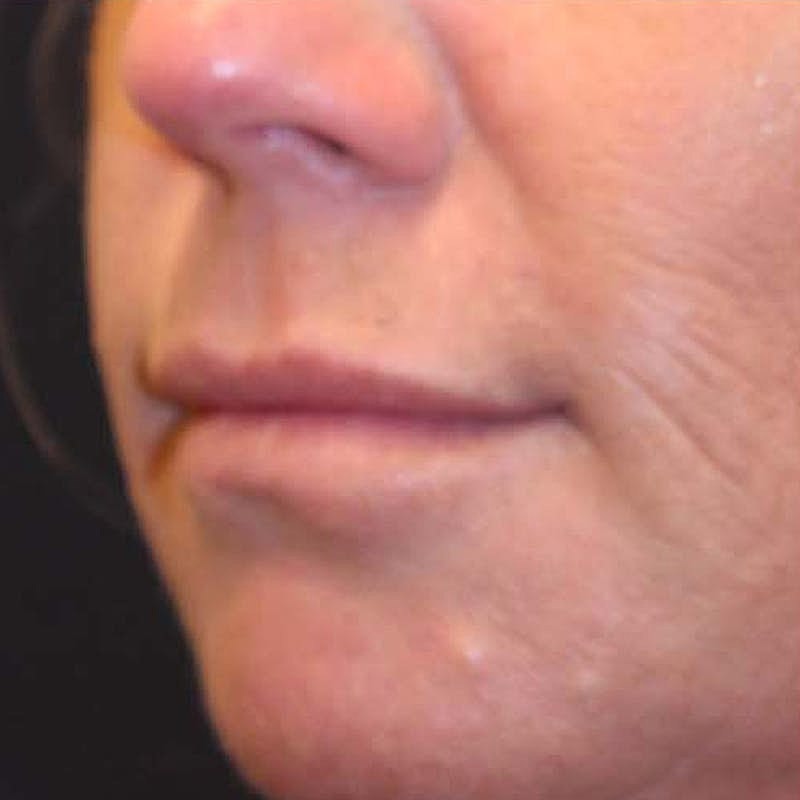 Dermal Fillers Before & After