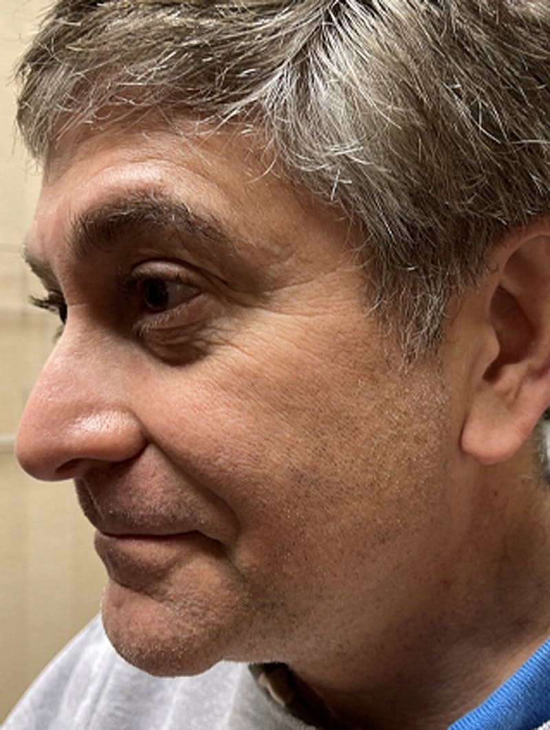 Dermal Fillers Before & After