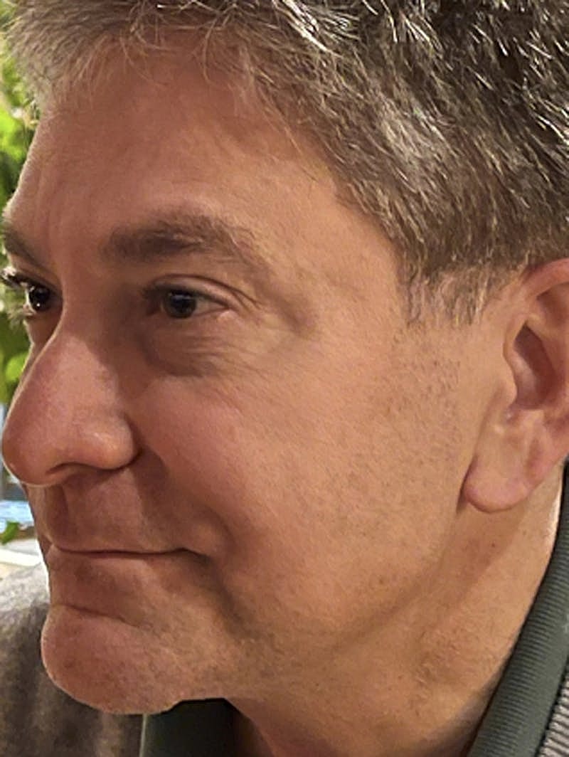 Dermal Fillers Before & After