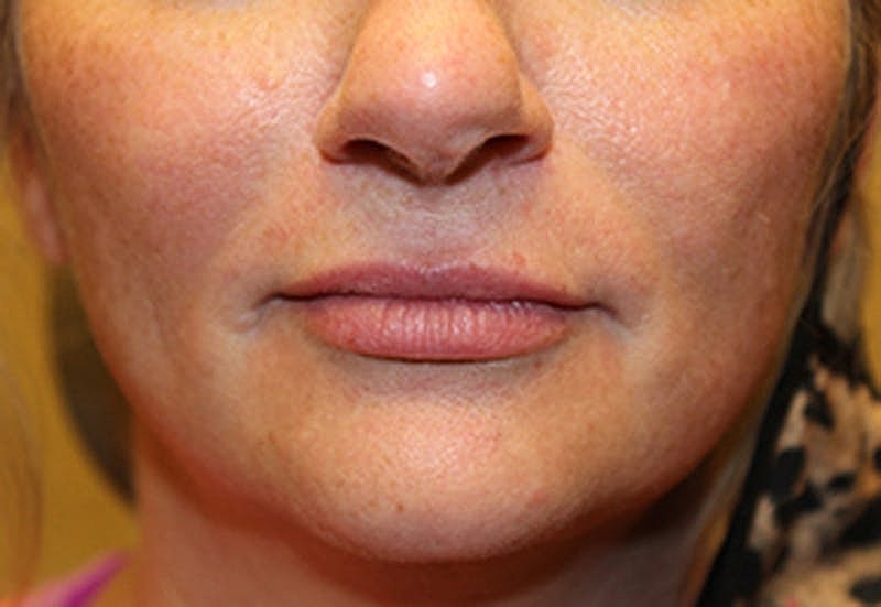 Dermal Fillers Before & After