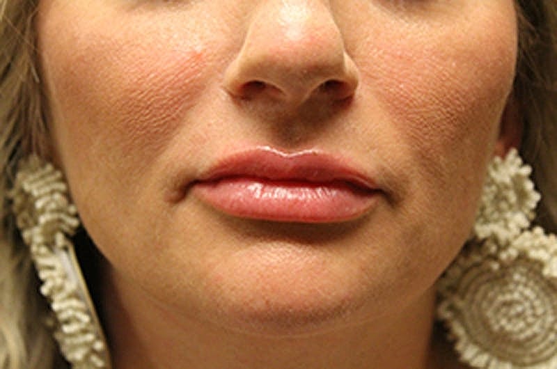 Dermal Fillers Before & After