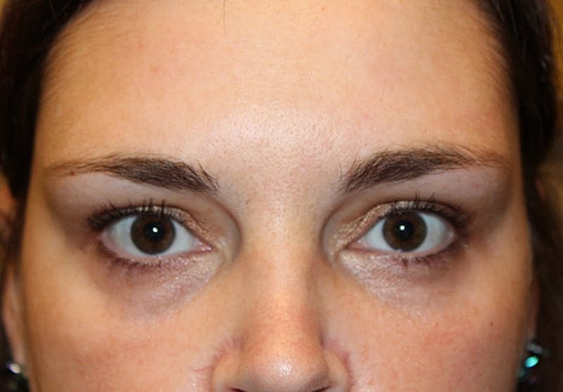 Dermal Fillers Before & After
