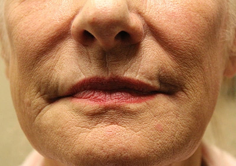 Dermal Fillers Before & After