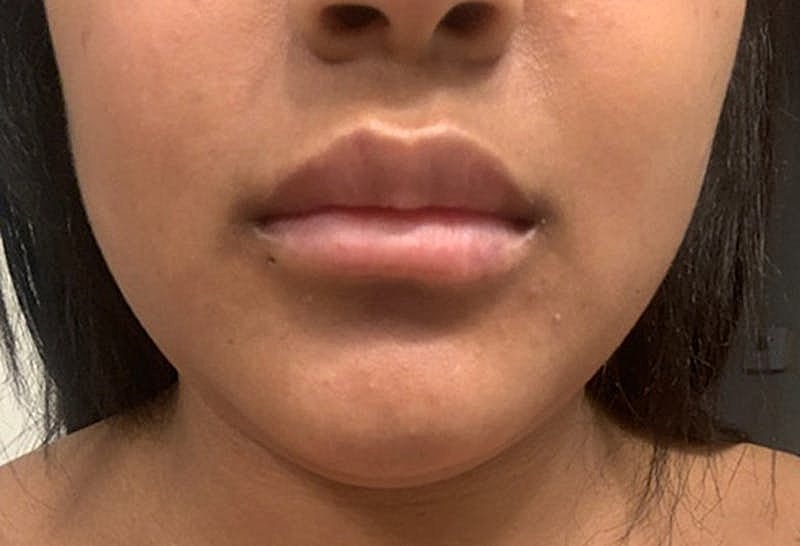 Dermal Fillers Before & After