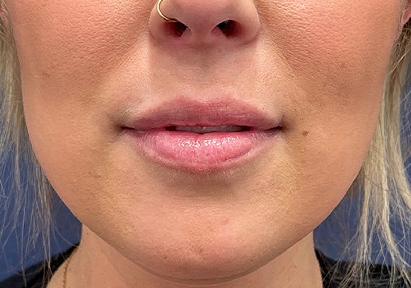Dermal Fillers Before & After