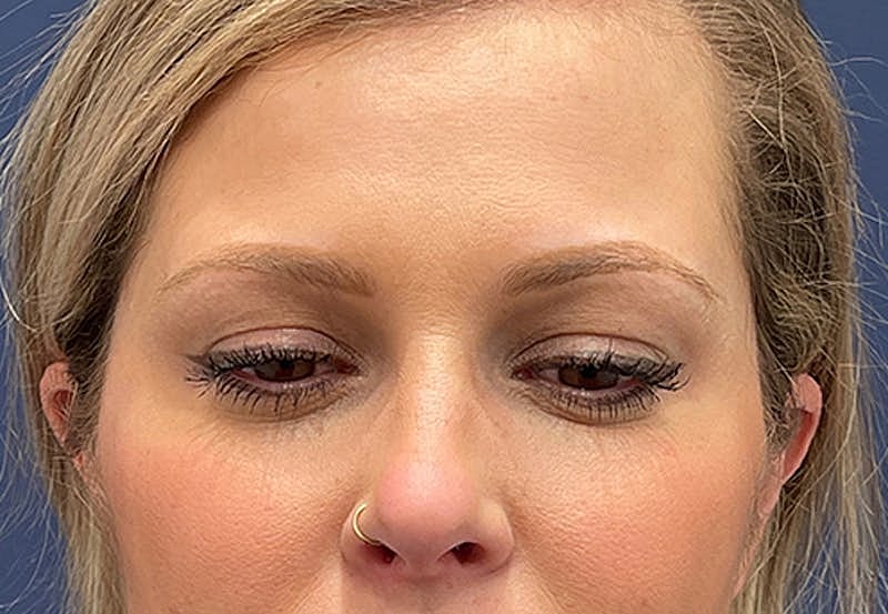 Dermal Fillers Before & After