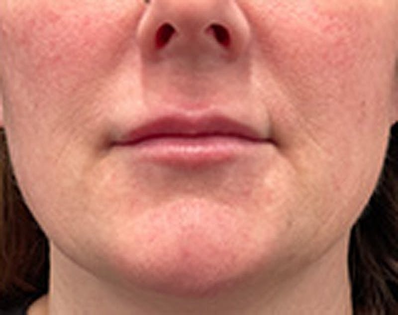 Dermal Fillers Before & After