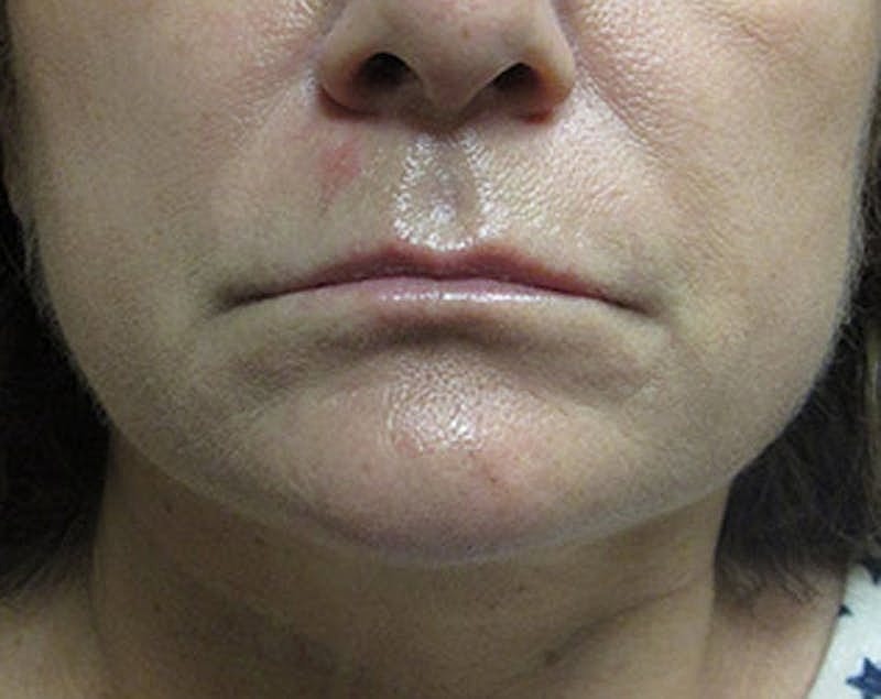 Dermal Fillers Before & After