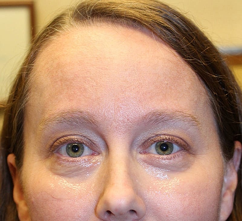 Dermal Fillers Before & After