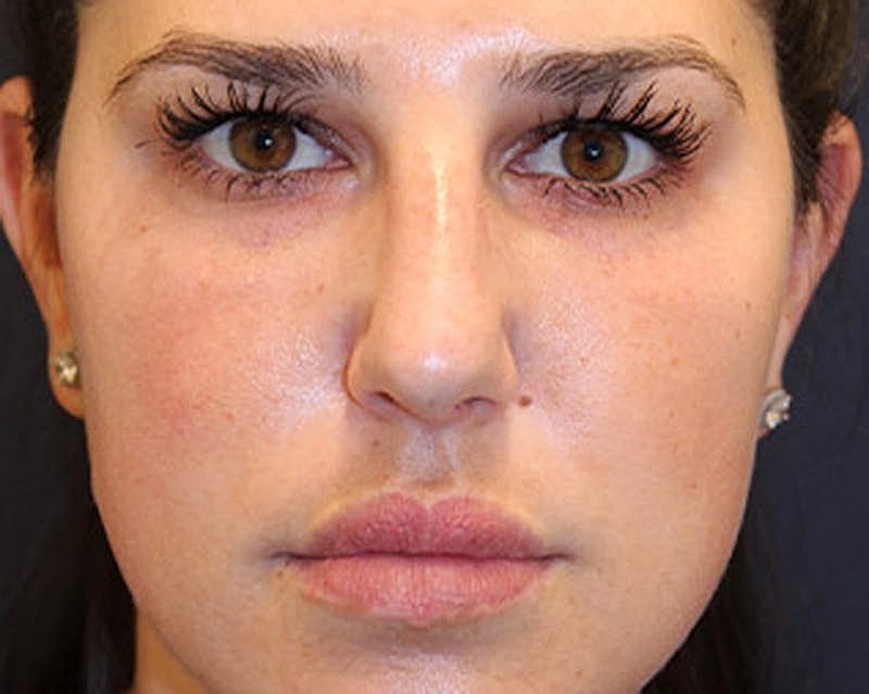 Dermal Fillers Before & After