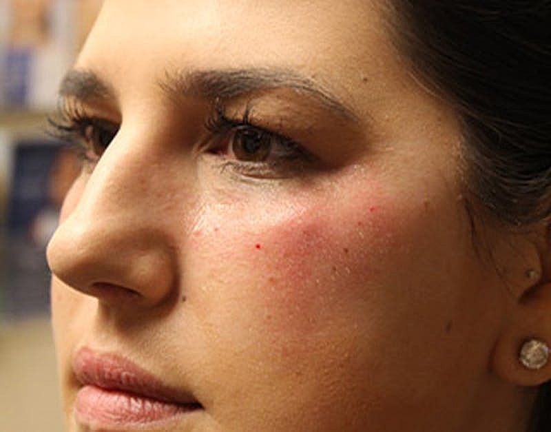 Dermal Fillers Before & After