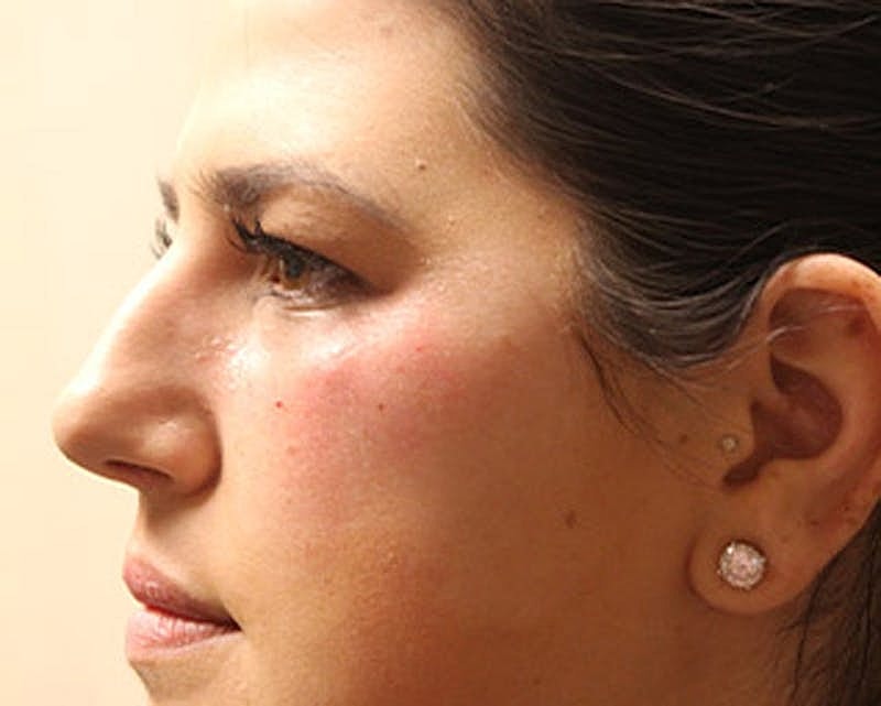 Dermal Fillers Before & After