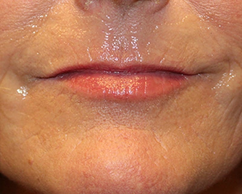 Dermal Fillers Before & After