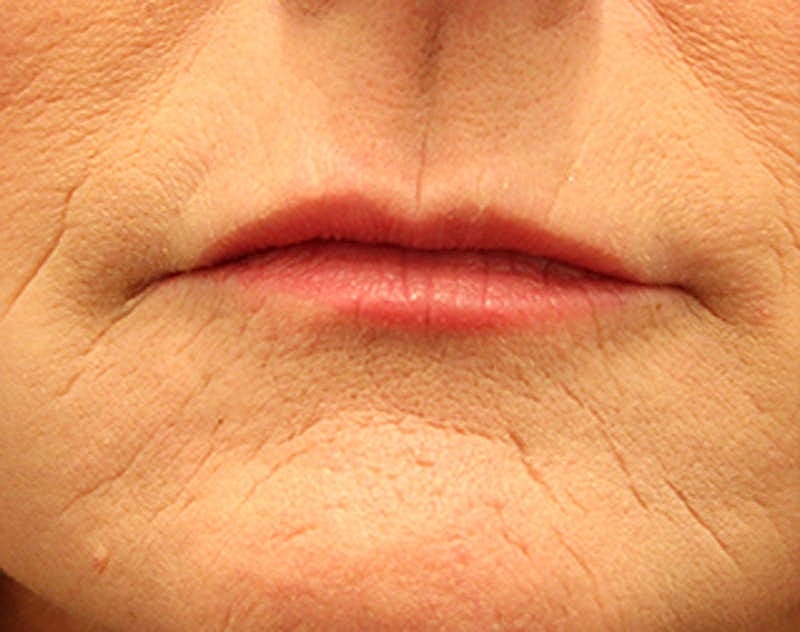 Dermal Fillers Before & After