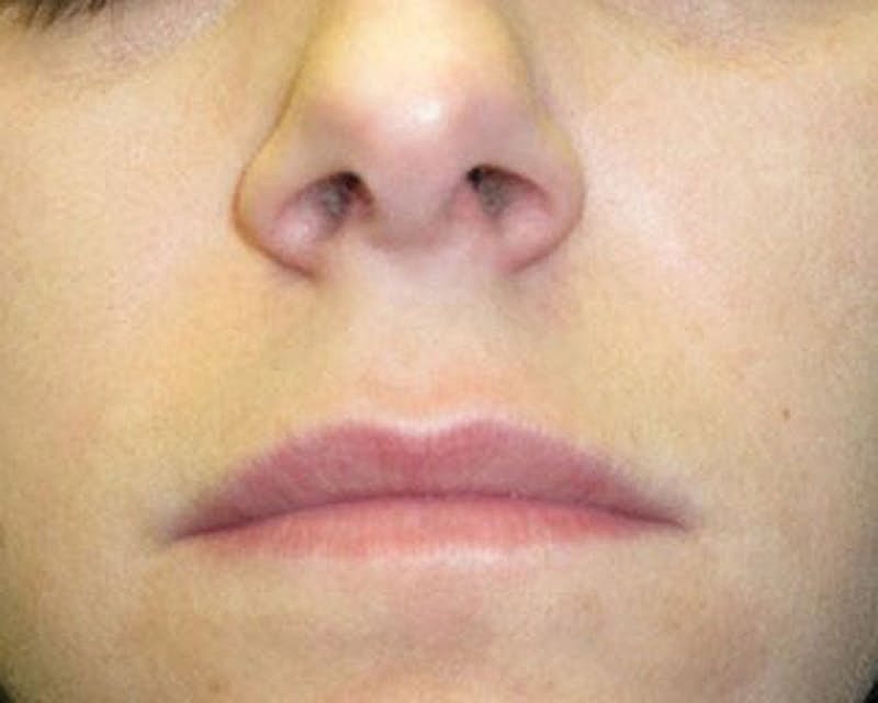 Dermal Fillers Before & After