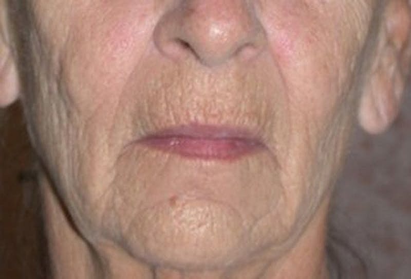 Dermal Fillers Before & After