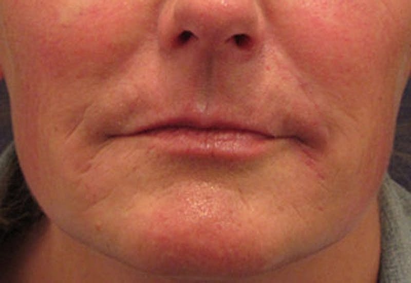 Dermal Fillers Before & After