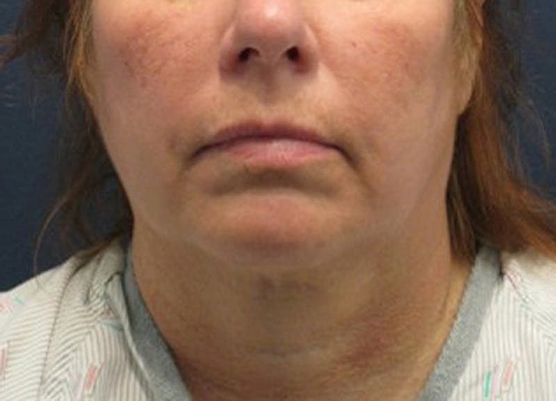 Dermal Fillers Before & After