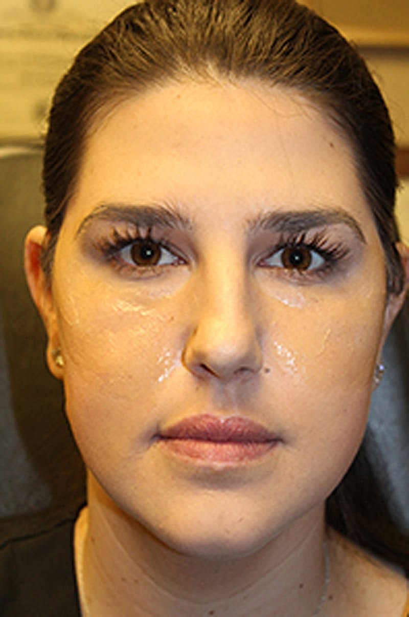 Dermal Fillers Before & After