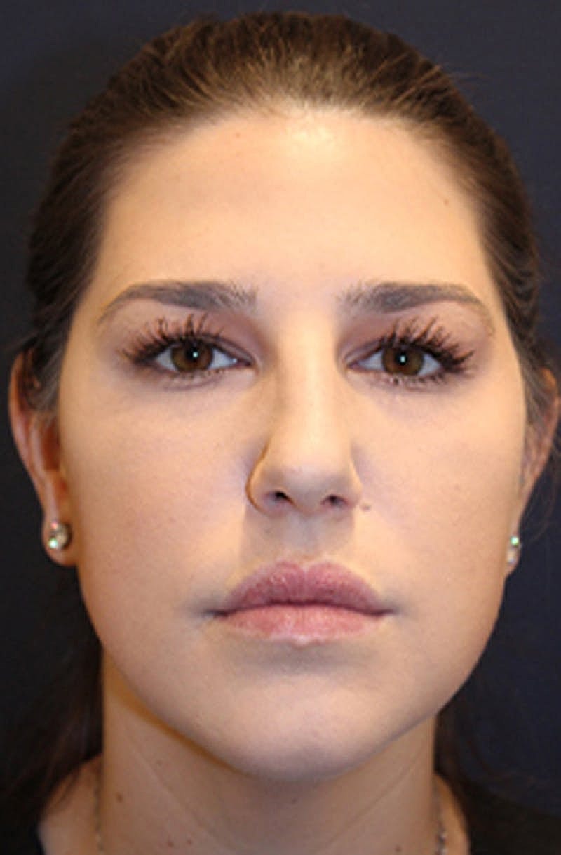 Dermal Fillers Before & After
